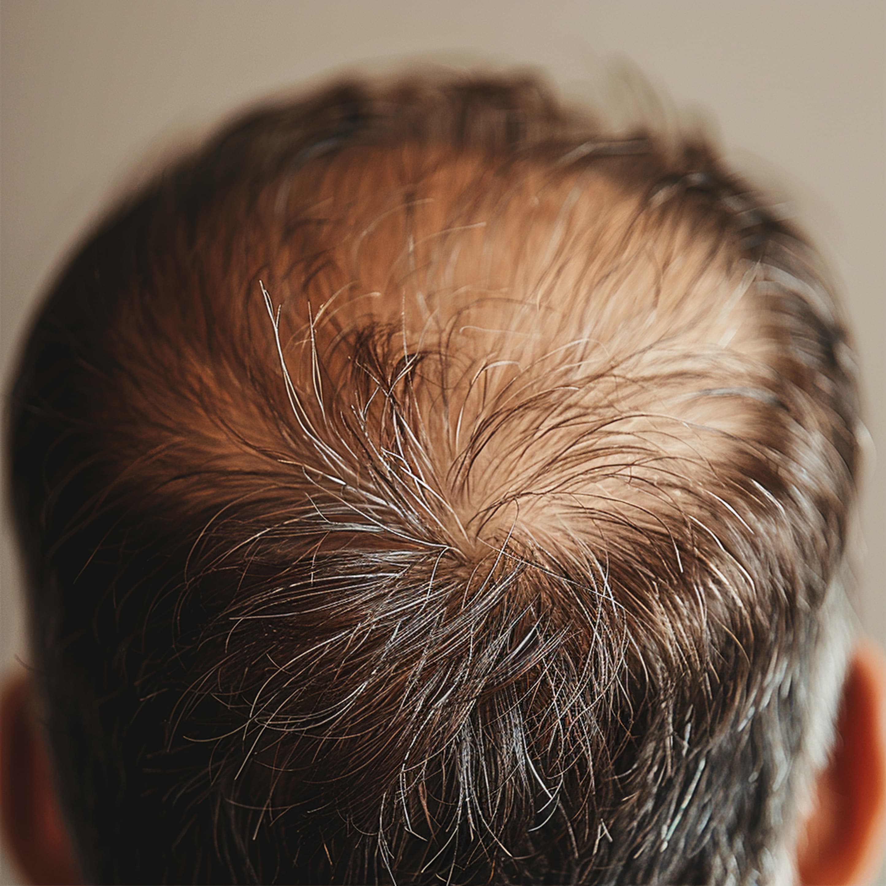 hair restoration